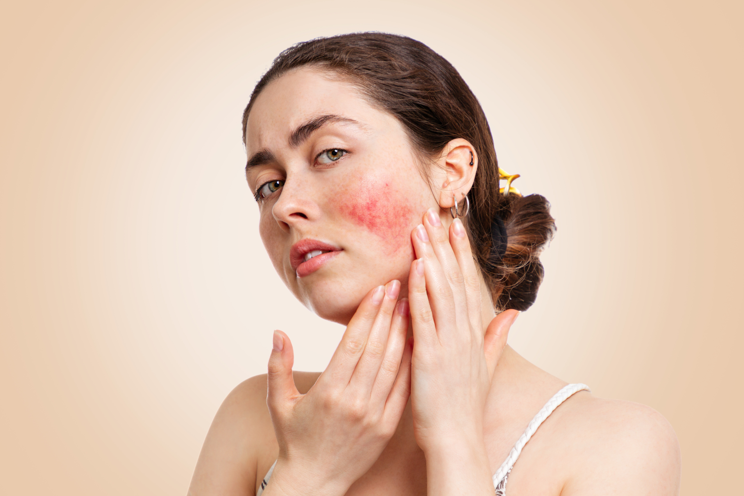 Young woman frowning with rosacea